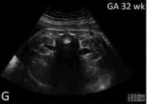 Εμβρυο 32 εβδομάδων . Φυσιολογική διάταση 8 mm .